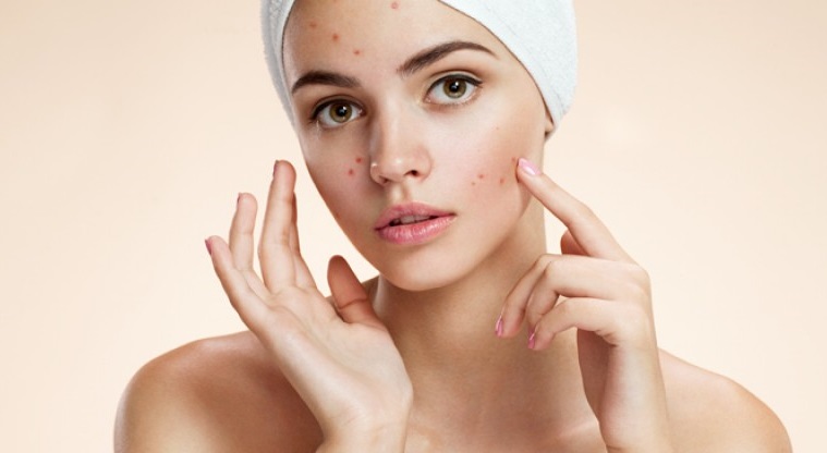 Blackheads Causes Symptoms Prevention and Treatment