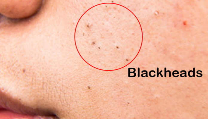 What are Blackheads 696x400