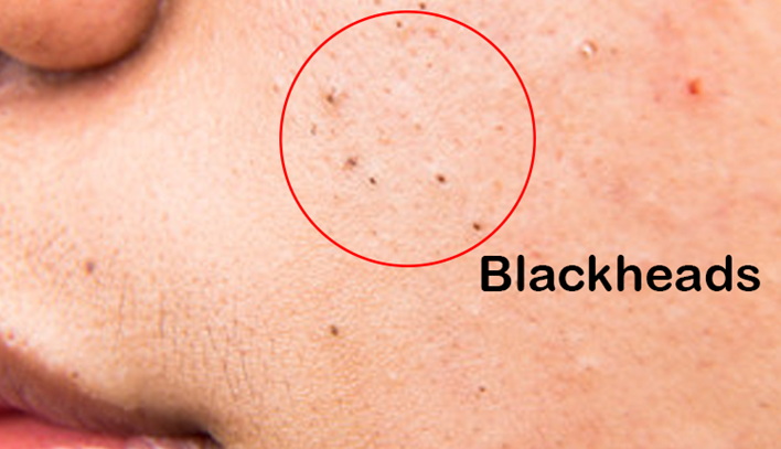 What are Blackheads