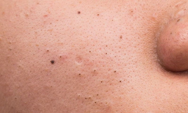 Do's and Don'ts to Prevent Blackheads