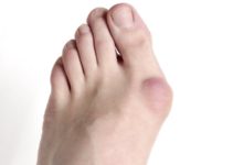 Bunion Surgery - Preparation, Procedure and Recovery
