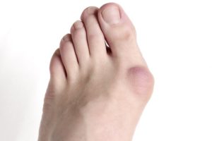 Bunion Surgery - Preparation, Procedure and Recovery